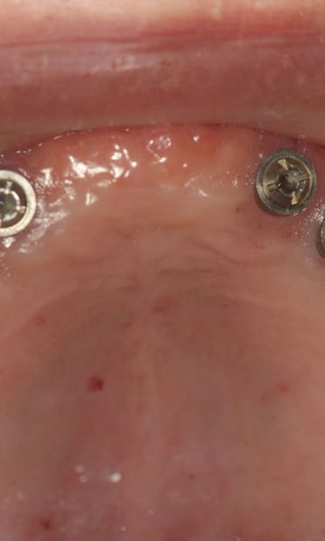 implantes (1)