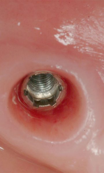 implantes (3)